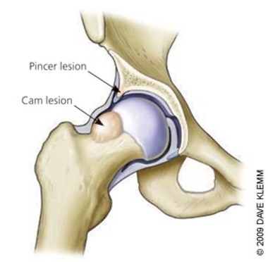 Lesions that occur Lesions that occur