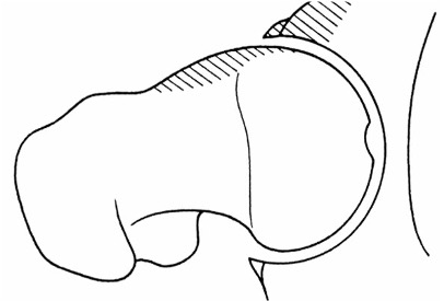 labral impingemen labral impingemen