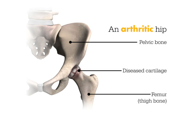 Arthritic-Hip-Before-Mako-Surgery