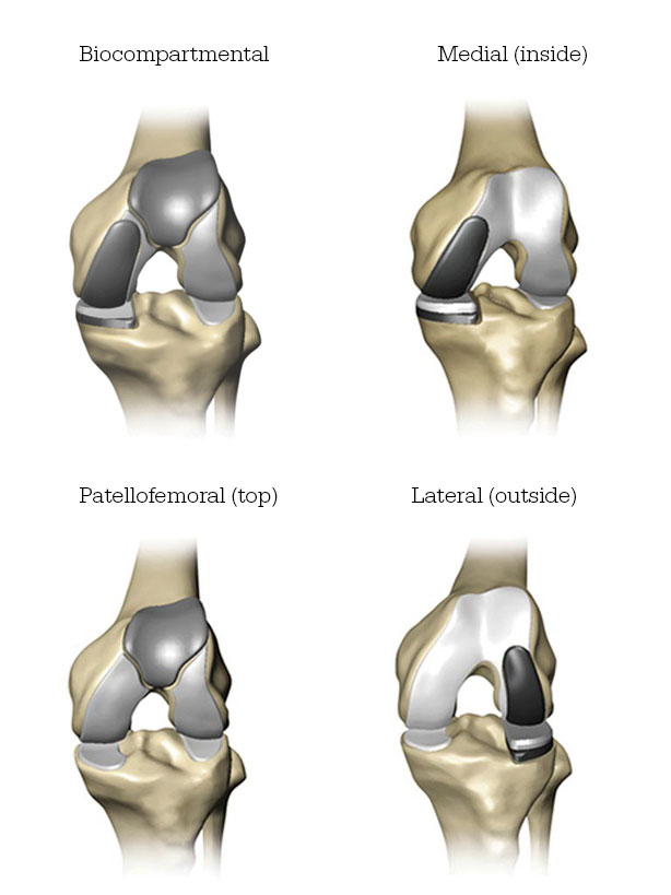 knee joint replacement devices