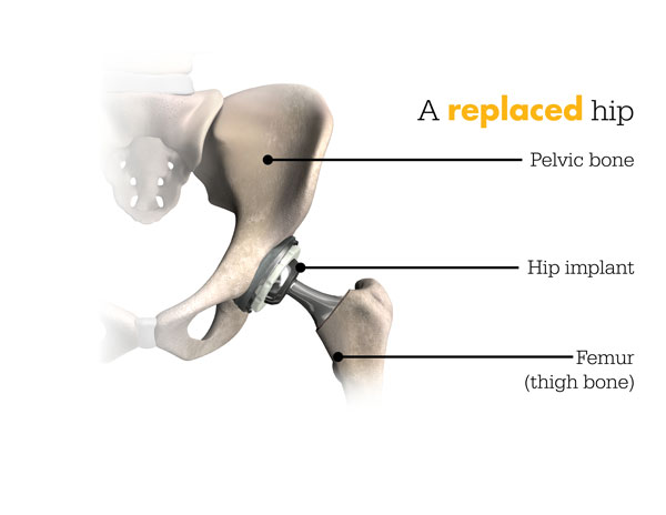 Replaced-Hip-After-Mako-Surgery